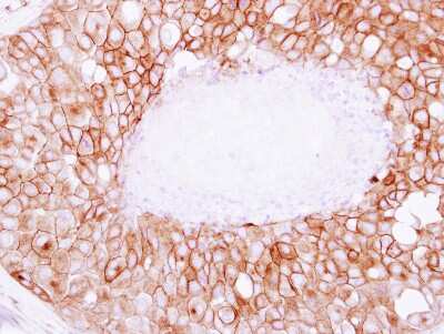 Immunohistochemistry-Paraffin: SNAP23 Antibody [NBP2-20434] - Immunohistochemical analysis of paraffin-embedded Breast ca, using antibody at 1:250 dilution.