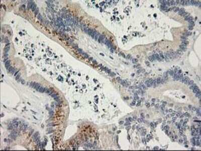 Immunohistochemistry: SNAP25 Antibody (OTI4G5) - Azide and BSA Free [NBP2-74245] - Staining of paraffin-embedded Adenocarcinoma of Human colon tissue using anti-SNAP25 mouse monoclonal antibody.