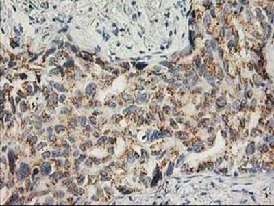 Immunohistochemistry: SNAP25 Antibody (OTI4G5) - Azide and BSA Free [NBP2-74245] - Staining of paraffin-embedded Carcinoma of Human lung tissue using anti-SNAP25 mouse monoclonal antibody.