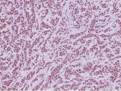 Immunohistochemistry-Paraffin: SNF5 Antibody (SMARCB1/4587R) [NBP3-13776] - Formalin-fixed, paraffin-embedded human sarcoma stained with SNF5 antibody (SMARCB1/4587R)