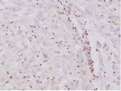 Immunohistochemistry-Paraffin: SNF5 Antibody (SMARCB1/4587R) [NBP3-13776] - Formalin-fixed, paraffin-embedded human epithelioid sarcoma stained with SNF5 antibody (SMARCB1/4587R).