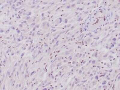 Immunohistochemistry-Paraffin: SNF5 Antibody (rSMARCB1/4588) [NBP3-13775] - Formalin-fixed, paraffin-embedded human epithelioid sarcoma stained with SNF5 antibody (rSMARCB1/4588). Note loss of nuclear expression in tumor cells and retained positivity in normal cells.