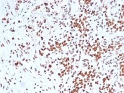 Immunohistochemistry-Paraffin: SNF5 Antibody (rSMARCB1/4588) [NBP3-13775] - Formalin-fixed, paraffin-embedded human Ewing sarcoma stained with SNF5 antibody (rSMARCB1/4588). HIER: Tris/EDTA, pH9.0, 45min. HRP-polymer, 30min. DAB, 5min.