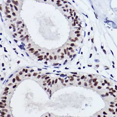 Immunohistochemistry-Paraffin: SNRPA1 Antibody (2D7M1) [NBP3-15292] - Immunohistochemistry of paraffin-embedded human breast cancer using SNRPA1 Rabbit mAb (NBP3-15292) at dilution of 1:100 (40x lens).Perform high pressure antigen retrieval with 10 mM citrate buffer pH 6.0 before commencing with IHC staining protocol.