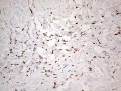 Immunohistochemistry: SNRPB2 Antibody (OTI2A5) - Azide and BSA Free [NBP2-74260] - Analysis of Carcinoma of Human bladder tissue. (Heat-induced epitope retrieval by 1mM EDTA in 10mM Tris buffer (pH8.5) at 120C for 3 min)