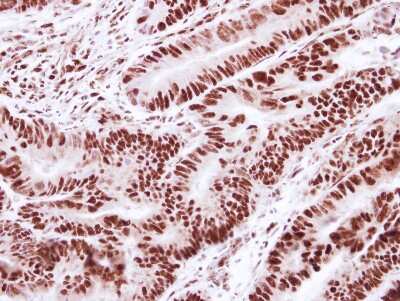 Immunohistochemistry-Paraffin: SNRPD2 Antibody [NBP2-20438] - Immunohistochemical analysis of paraffin-embedded Colon ca, using antibody at 1:250 dilution.