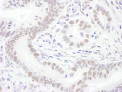 Immunohistochemistry-Paraffin: SNRPD3 Antibody [NBP2-22306] - Sample: FFPE section of human stomach carcinoma. Antibody: Affinity purified rabbit anti- Sm-D3 used at a dilution of 1:1,000 (1ug/ml). Detection: DAB. Counterstain: hematoxylin (blue).