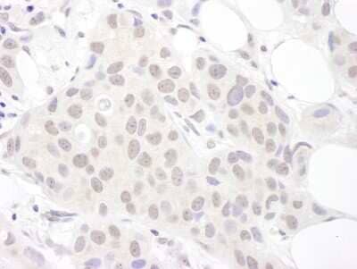 <b>Biological Strategies Validation. </b>Immunohistochemistry-Paraffin: SNRPD3 Antibody [NBP2-22305] - Sample: FFPE section of human breast carcinoma. Antibody: Affinity purified rabbit anti- Sm-D3 used at a dilution of 1:1,000 (1ug/ml). Detection: DAB. Counterstain: hematoxylin (blue).