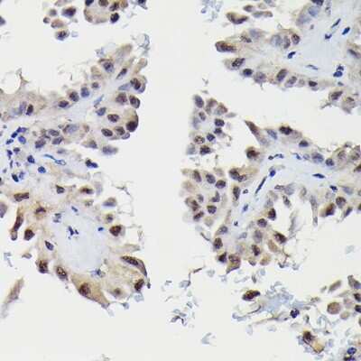 Immunohistochemistry-Paraffin: SNRPE Antibody [NBP2-94255] - Immunohistochemistry of paraffin-embedded human thyroid cancer using SNRPE Rabbit pAb (NBP2-94255) at dilution of 1:50 (40x lens). Perform high pressure antigen retrieval with 10 mM citrate buffer pH 6.0 before commencing with IHC staining protocol.