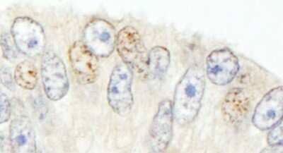 <b>Independent Antibodies Validation and Biological Strategies Validation.</b>Immunohistochemistry-Paraffin: SNW1 Antibody [NB100-2367] - Sample: FFPE section of human prostate carcinoma. Antibody: Affinity purified rabbit anti- NCOA62 used at a dilution of 1:1,000 (1ug/ml). Detection: DAB