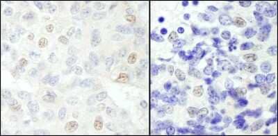 <b>Independent Antibodies Validation and Biological Strategies Validation.</b>Immunohistochemistry-Paraffin: SNW1 Antibody [NB100-2368] - Section of human breast carcinoma (left) and mouse teratoma (right). Antibody: Affinity purified rabbit anti- NCOA62 used at a dilution of 1:200 (1ug/ml). Detection: DAB