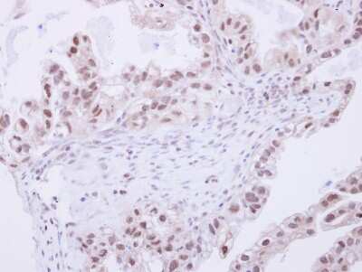 Immunohistochemistry-Paraffin: SNW1 Antibody [NBP2-20440] - Immunohistochemical analysis of paraffin-embedded OVCA, using antibody at 1:250 dilution.