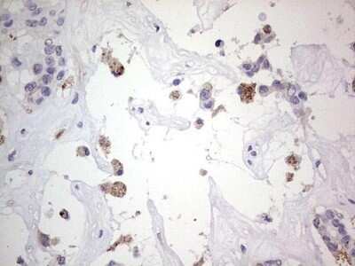 Immunohistochemistry: SNX12 Antibody (OTI3A4) - Azide and BSA Free [NBP2-74263] - Analysis of Carcinoma of Human liver tissue.(Heat-induced epitope retrieval by 1 mM EDTA in 10mM Tris, pH8.5, 120C for 3min)