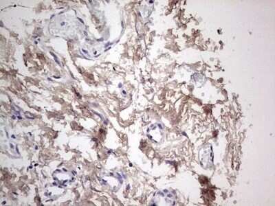 Immunohistochemistry: SNX12 Antibody (OTI3A4) - Azide and BSA Free [NBP2-74263] - Analysis of Carcinoma of Human pancreas tissue. (Heat-induced epitope retrieval by 1 mM EDTA in 10mM Tris, pH8.5, 120C for 3min)