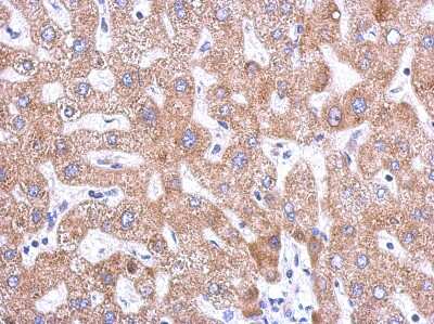 Immunohistochemistry-Paraffin: SNX18 Antibody [NBP2-20444] -   Human hepatoma, using SNX18 antibody at 1:500 dilution.  Antigen Retrieval: Trilogy™ (EDTA based, pH 8.0) buffer, 15min.