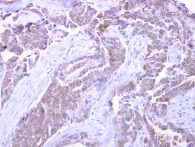 Immunohistochemistry-Paraffin: SNX33 Antibody [NBP2-20447] - Lung adenocarcinoma. SNX33 antibody dilution: 1:500. Antigen Retrieval: Trilogy™ (EDTA based, pH 8.0) buffer, 15min. 