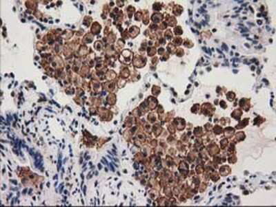 Immunohistochemistry-Paraffin: SNX8 Antibody (1E5) [NBP2-03367] - Staining of paraffin-embedded Carcinoma of Human lung tissue using anti-SNX8 mouse monoclonal antibody.