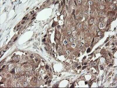 Immunohistochemistry: SNX8 Antibody (OTI1A1) - Azide and BSA Free [NBP2-74265] - Analysis of Adenocarcinoma of Human breast tissue.