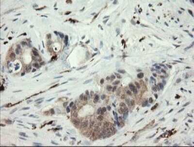 Immunohistochemistry: SNX8 Antibody (OTI1A1) - Azide and BSA Free [NBP2-74265] - Analysis of Adenocarcinoma of Human colon tissue.