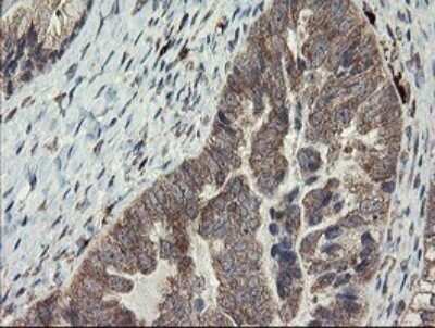 Immunohistochemistry: SNX8 Antibody (OTI1A1) - Azide and BSA Free [NBP2-74265] - Analysis of Adenocarcinoma of Human ovary tissue.