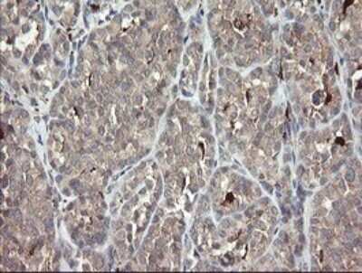 Immunohistochemistry: SNX8 Antibody (OTI1A1) [NBP2-45896] - Analysis of Carcinoma of Human thyroid tissue.