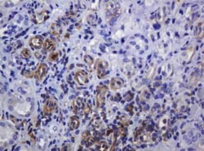 Immunohistochemistry: SOAT 2 Antibody (OTI2D3) - Azide and BSA Free [NBP2-74271] - Analysis of Adenocarcinoma of Human colon tissue. (Heat-induced epitope retrieval by 10mM citric buffer, pH6.0, 120C for 3min)