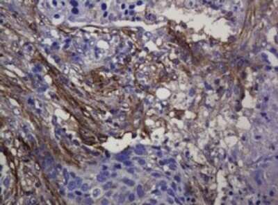 Immunohistochemistry: SOAT 2 Antibody (OTI2D3) - Azide and BSA Free [NBP2-74271] - Analysis of Carcinoma of Human lung tissue. (Heat-induced epitope retrieval by 10mM citric buffer, pH6.0, 120C for 3min)