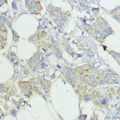 Immunohistochemistry-Paraffin: SOCS-6 Antibody [NBP2-94197] - Paraffin-embedded human mammary cancer using SOCS-6 .