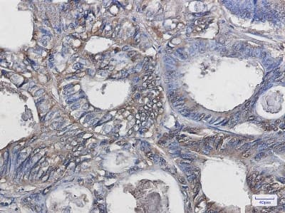 Immunohistochemistry-Paraffin: SOD1/Cu-Zn SOD Antibody (S07-1G6) [NBP3-14886] - Immunohistochemistry of SOD1/Cu-Zn SOD in paraffin-embedded Human colon cancer tissue using SOD1/Cu-Zn SOD Rabbit mAb at dilution 1/20