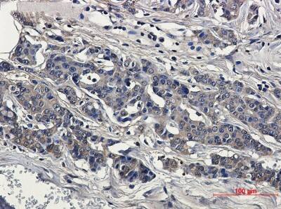 Immunohistochemistry-Paraffin: SOD1/Cu-Zn SOD Antibody (S08-5A5) [NBP3-20005] - Immunohistochemical of SOD1/Cu-Zn SOD in Human breast cancer tissue using NBP3-20005 at dilution 1/50