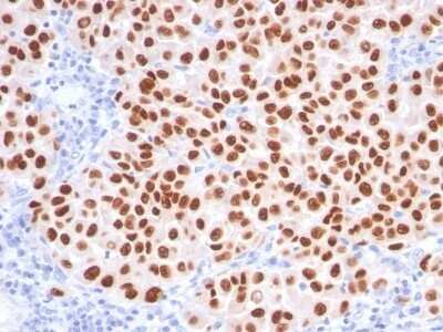 Immunohistochemistry-Paraffin: SOX10 Antibody (SOX10/991 + SOX10/1074) - Azide and BSA Free [NBP2-47709] - Human Melanoma stained with SOX10 Monoclonal Antibody (SOX10/991 + SOX10/1074).