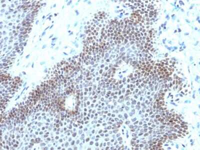 Immunohistochemistry-Paraffin: SOX11 Antibody (SOX11/3235R) - Azide and BSA Free [NBP3-08594] - Formalin-fixed, paraffin-embedded human cervical carcinoma stained with SOX11 Recombinant Rabbit Monoclonal Antibody (SOX11/3235R).