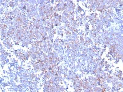 Immunohistochemistry-Paraffin: SOX11 Antibody (SOX11/3235R) - Azide and BSA Free [NBP3-08594] - Formalin-fixed, paraffin-embedded human mantle cell lymphoma stained with SOX11 Recombinant Rabbit Monoclonal Antibody (SOX11/3235R).