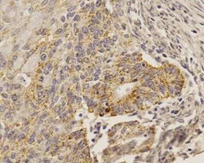 Immunocytochemistry: SOX2 Antibody (4G8) - Azide and BSA Free [NBP2-80957] - IHC analysis of formalin-fixed paraffin-embedded tissue section of human uterine cancer using mouse monoclonal SOX2 antibody (clone 4G8) at 5 ug/ml concentration. The cancer cells developed a punctate staining in the cytoplasm and nuclei, whereas the stro