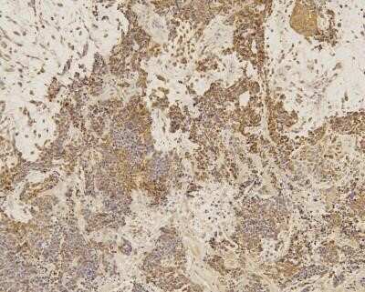 Immunohistochemistry: SOX2 Antibody (4G8) - Azide and BSA Free [NBP2-80957] - IHC analysis of formalin-fixed paraffin-embedded tissue section of human bladder cancer using mouse monoclonal SOX2 antibody (clone 4G8) at 5 ug/ml concentration. The cancer cells developed a cytoplasmic and nuclear immunepositivity for SOX2 protein [Magn