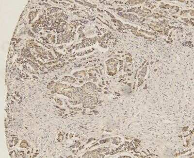 Immunohistochemistry: SOX2 Antibody (4G8) - Azide and BSA Free [NBP2-80957] - IHC analysis of formalin-fixed paraffin-embedded tissue section of human breast cancer using mouse monoclonal SOX2 antibody (clone 4G8) at 5 ug/ml concentration. The cancer cells developed a cytoplasmic and nuclear immunepositivity, whereas the stroma was