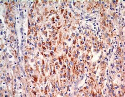 Immunohistochemistry: SOX2 Antibody (4G8) - Azide and BSA Free [NBP2-80957] - IHC-P analysis of SOX2 protein in a section of human renal cell carcinoma using 5 ug/ml concentration of SOX2 antibody (clone 4G8). Granular nuclear and cytoplasmic staining pattern was observed in the carcinoma cells, whereas, a weak to negligible staini