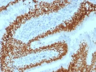 Immunohistochemistry-Paraffin: SOX2 Antibody (SOX2/1792) - Azide and BSA Free [NBP2-54593] - Formalin-fixed, paraffin-embedded human Lung Carcinoma stained with SOX2 Antibody (SOX2/1792).