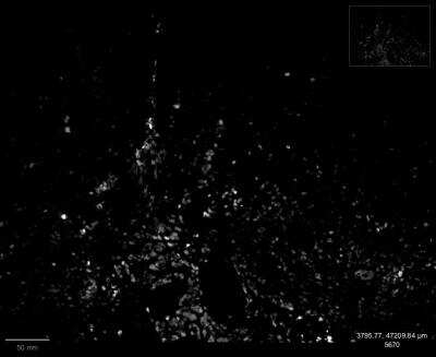 Immunohistochemistry-Paraffin: SOX2 Antibody (SOX2/1792) - Azide and BSA Free [NBP2-54593] - Analysis of SOX2 stained human head-neck cancer sample. Image from verified customer review.