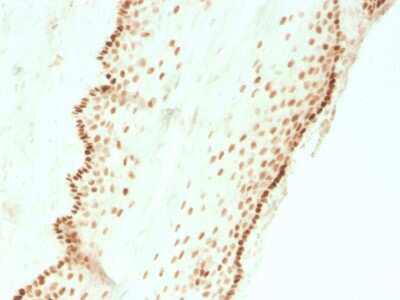 Immunohistochemistry-Paraffin: SOX2 Antibody (SOX2/3811R) - Azide and BSA Free [NBP3-08524] - Formalin-fixed, paraffin-embedded human cervical carcinoma stained with SOX2 Recombinant Rabbit Monoclonal Antibody (SOX2/3811R).