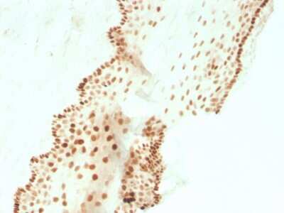 Immunohistochemistry-Paraffin: SOX2 Antibody (SOX2/3811R) - Azide and BSA Free [NBP3-08524] - Formalin-fixed, paraffin-embedded human cervical carcinoma stained with SOX2 Recombinant Rabbit Monoclonal Antibody (SOX2/3811R).