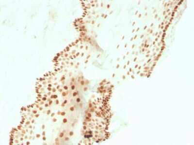 Immunohistochemistry-Paraffin: SOX2 Antibody (SOX2/3811R) [NBP3-07893] - Formalin-fixed, paraffin-embedded human cervical carcinoma stained with SOX2 Recombinant Rabbit Monoclonal Antibody (SOX2/3811R).