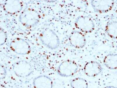 Immunohistochemistry-Paraffin: SOX4 Antibody (SOX4/2540) - Azide and BSA Free [NBP2-79903] - Formalin-fixed, paraffin-embedded human Colon Carcinoma stained with SOX4 Mouse Monoclonal Antibody (SOX4/2540).