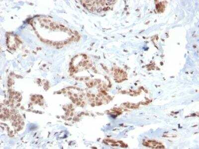 Immunohistochemistry-Paraffin: SOX4 Antibody (SOX4/2540) - Azide and BSA Free [NBP2-79903] - Formalin-fixed, paraffin-embedded human Breast Carcinoma stained with SOX4 Mouse Monoclonal Antibody (SOX4/2540).