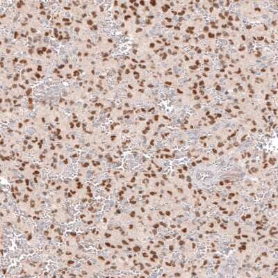 Immunohistochemistry-Paraffin: SOX6 Antibody (CL5690) [NBP2-61423] - Staining of human glioma shows moderate to strong nuclear positivity in tumor cells.