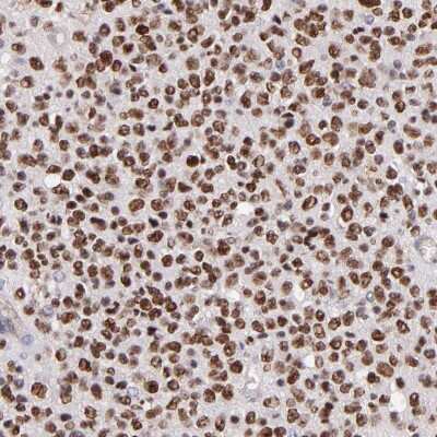 Immunohistochemistry-Paraffin: SOX6 Antibody [NBP1-85811] - Staining of human glioma shows moderate to strong nuclear positivity in tumor cells.