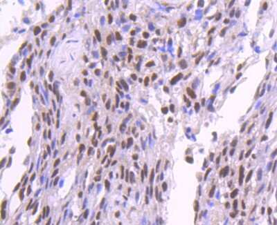 Immunohistochemistry-Paraffin: SP1 Antibody (JF0950) [NBP2-67159] - Analysis of paraffin-embedded human breast carcinoma tissue using anti-SP1 antibody. Counter stained with hematoxylin.