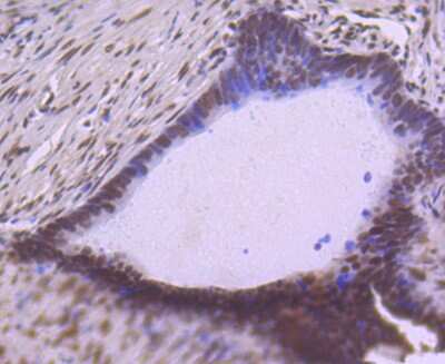 Immunohistochemistry-Paraffin: SP1 Antibody (JF0950) [NBP2-67159] - Analysis of paraffin-embedded human colon cancer tissue using anti-SP1 antibody. Counter stained with hematoxylin.