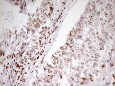 Immunohistochemistry: SP110 Antibody (OTI4C1) - Azide and BSA Free [NBP2-74306] - Analysis of Adenocarcinoma of Human endometrium tissue. (Heat-induced epitope retrieval by 1 mM EDTA in 10mM Tris, pH8.5, 120C for 3min)