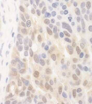 Immunohistochemistry: SPATA2 Antibody [NBP2-04071] - Sample: FFPE section of human breast carcinoma. Antibody: Affinity purified rabbit anti-SPATA2 used at a dilution of 1:250 Detection: DAB staining using Immunohistochemistry Accessory Kit